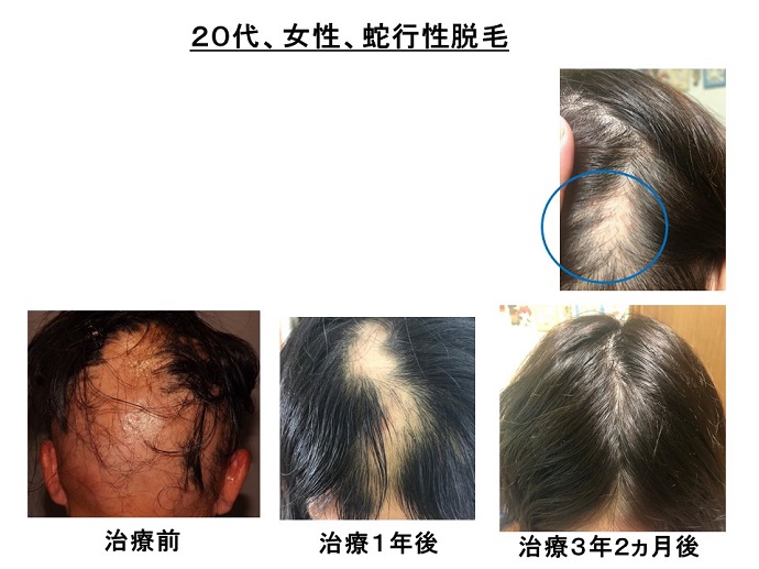 円形脱毛症　病院